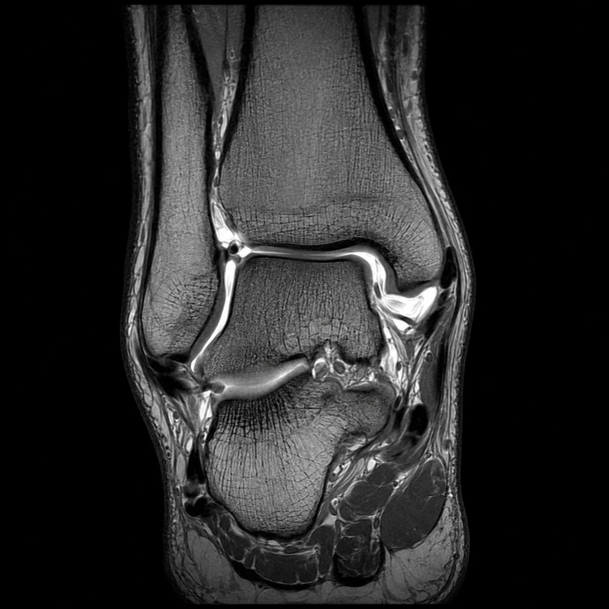 Coronal MRI scan of the ankle joint at MRI Jersey
