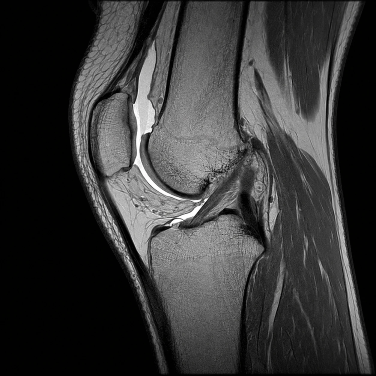 Sagittal MRI scan of the knee joint at MRI Jersey
