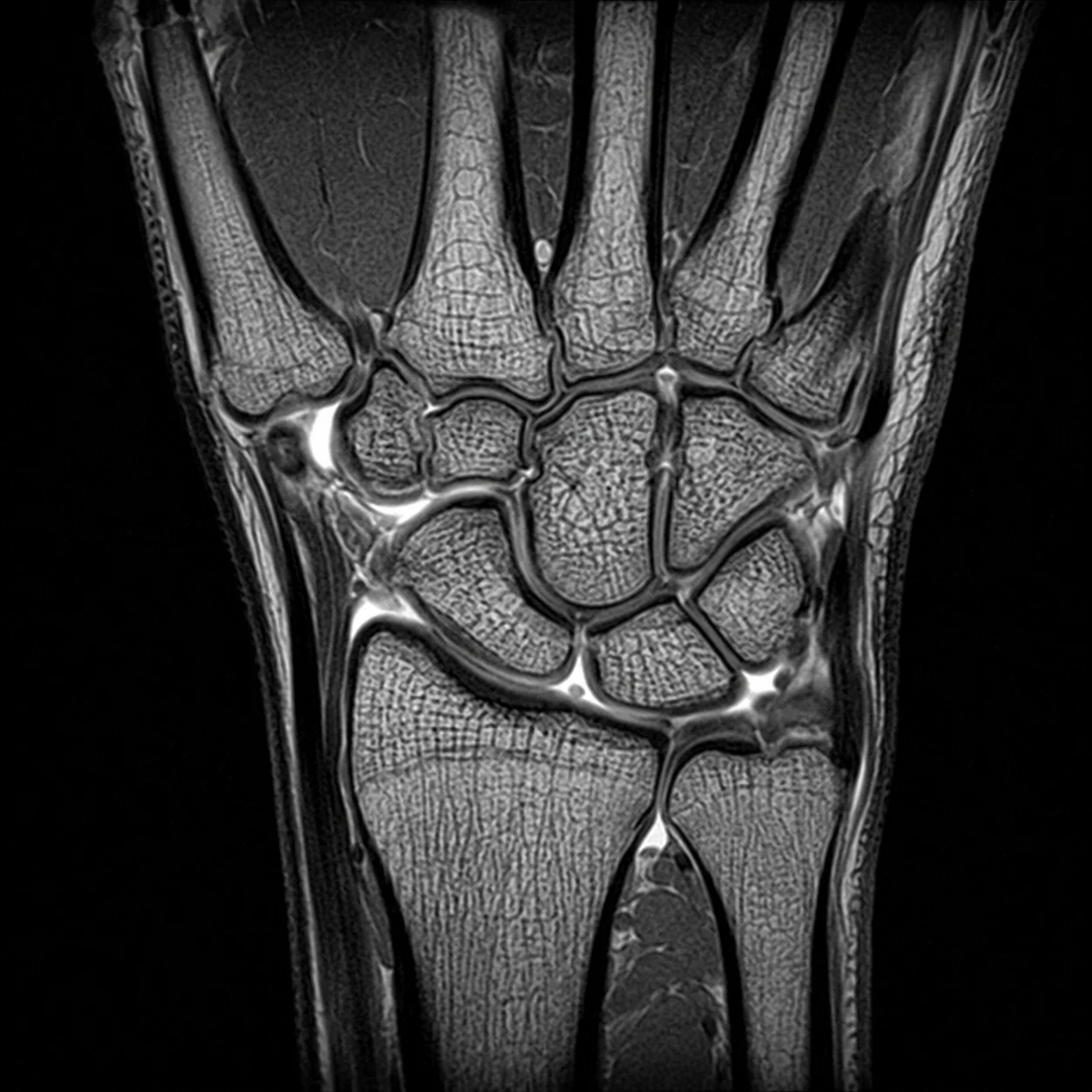Coronal MRI scan of the wrist joint at MRI Jersey